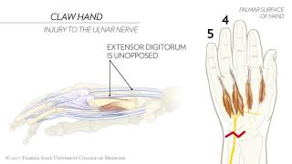 Claw Hand Ape Hand and the Sign of Benediction Animated Review [upl. by Neville556]