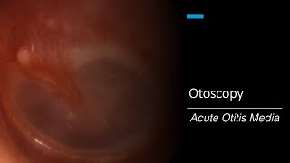 Acute Otitis Media Otoscopy [upl. by Choo]