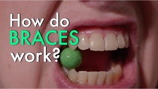 How Do Braces Work [upl. by Tegirb]