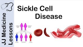 Hydroxyurea IntoleranceResistance in Polycythemia vera [upl. by Kramal]