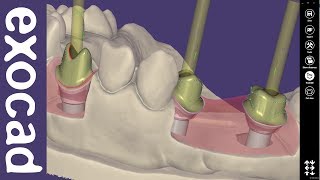 exocad Video Tutorial basic Custom Abutment Design [upl. by Hong]