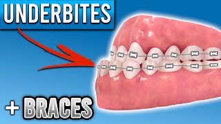 How Do Braces Fix Underbites  Premier Orthodontics [upl. by Parshall949]