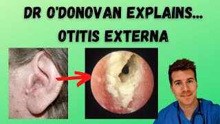 Explaining Otitis Externa  With Dr ODonovan [upl. by Sitto]