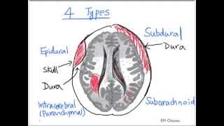 Intracranial Bleed  Part 1 [upl. by Kieffer]