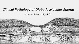 Clinical pathology of Diabetic Macular Edema [upl. by Ailel]