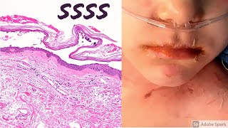 Staphylococcal scalded skin syndrome SSSS 5Minute Pathology Pearls [upl. by Shaylynn132]