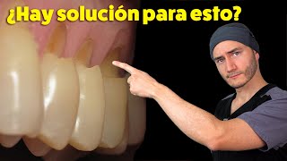 Desgastes en el cuello de los dientes  Causa y Solución  Abfracción Dental [upl. by Patsis]