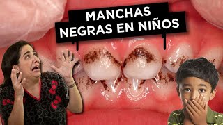 Manchas Negras en los Dientes ¿Qué debo hacer [upl. by Aicilf]