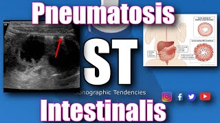 Pneumatosis Intestinalis [upl. by Morlee]