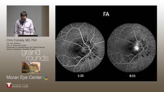 Optic Disc Edema and Choroidal Neovascular Membranes [upl. by Soane233]