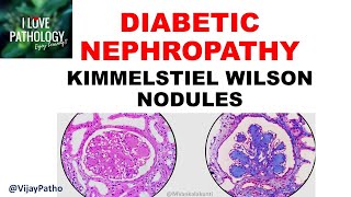 DIABETIC NEPHROPATHY Pathophysiology amp Morphology [upl. by Ewell76]