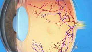 What is cystoid macular edema [upl. by Ahsea]