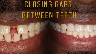 Closing Gaps Between Teeth With Braces [upl. by Laflam673]