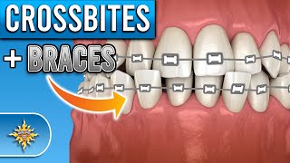 How Do BRACES Fix Crossbites [upl. by Gnuj]