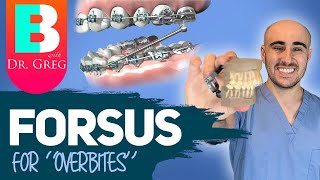 Braces Forsus for Overbite Overjet Correction [upl. by Meihar44]