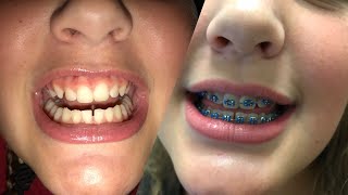 Getting Braces and Palate Expander [upl. by Enilav]