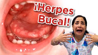 Herpes Bucal en Niños  Causas Síntomas y Tratamiento [upl. by Britt]