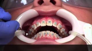 Getting Braces  How [upl. by Pen]