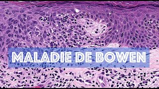 LA MALADIE DE BOWEN  PATHOLOGIE [upl. by Leahsim434]