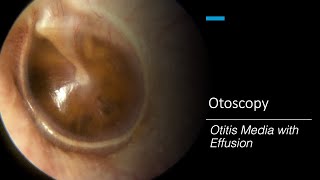 Otitis Media with Effusion Otoscopy [upl. by Karrah]