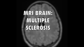 Multiple Sclerosis MRI [upl. by Arua]