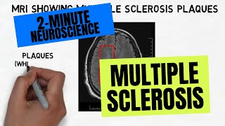 How we diagnose Multiple Sclerosis [upl. by Einra]