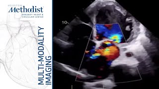 MitraClip  Minimally Invasive Mitral Valve Repair [upl. by Modestine]