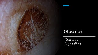 Cerumen Impaction Otoscopy [upl. by Aciamaj]