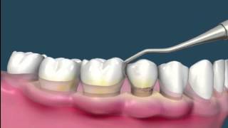 Raspado de encías  Periodoncia [upl. by Thorny110]