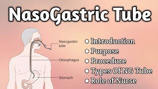 Nasogastric Tube Intubation [upl. by Oluap]