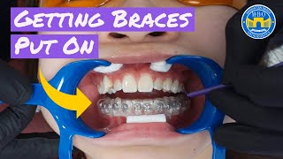 Process of Getting Braces [upl. by Townshend]