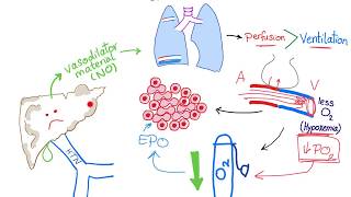 Hepatopulmonary syndrome [upl. by Tonry563]