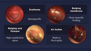 Acute Otitis Media Otoscopic Findings [upl. by Gregorius]