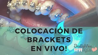 Colocación de Brackets en VIVO  Putting on Braces  LIVE [upl. by Ames]