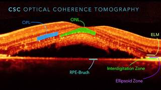 Central Serous Chorioretinopathy Part 2 [upl. by Sitto]