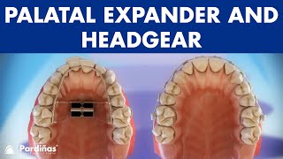 Orthodontic devices  Palatal expander and headgear © [upl. by Am]