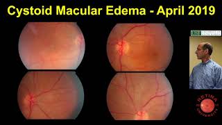 Cystoid Macular Edema [upl. by Bainbridge]